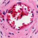 Soaring rates of peripheral artery disease, now over 200 million cases worldwide