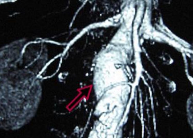 Endovascular repair of ruptured AAAs no better than open repair