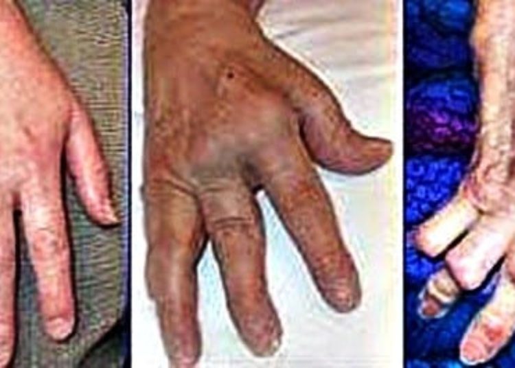 Combination therapy with tofacitinib improves response in rheumatoid arthritis