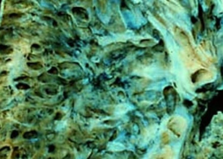 Ambrisentan found ineffective against idiopathic pulmonary fibrosis