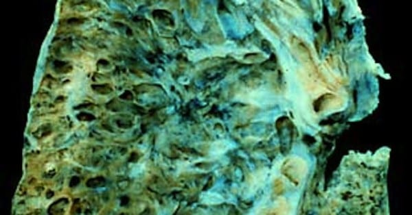 End-stage_interstitial_lung_disease_(honeycomb_lung)