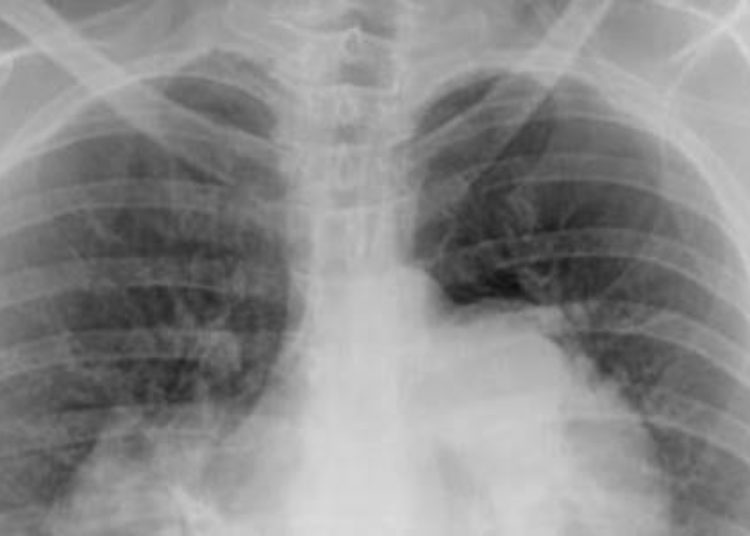 Macitentan better than placebo for preventing progression of pulmonary arterial hypertension [SERAPHIN Trial]
