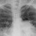 Macitentan better than placebo for preventing progression of pulmonary arterial hypertension [SERAPHIN Trial]