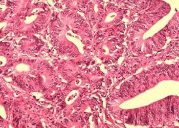 Fecal occult-blood testing linked with reduction in colorectal-cancer mortality