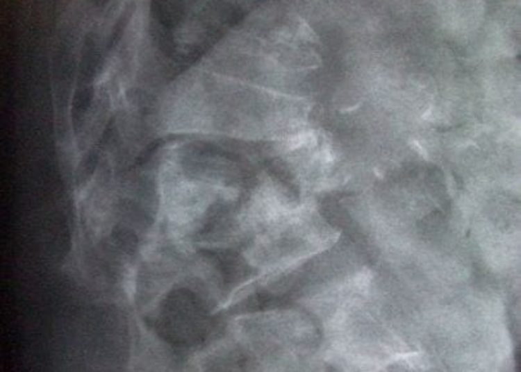 Repeat bone mineral density testing may not improve prediction of fracture outcomes