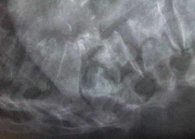 Repeat bone mineral density testing may not improve prediction of fracture outcomes
