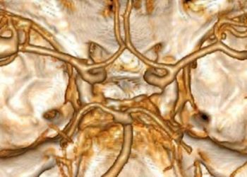Clinical decision rule highly sensitive in predicting subarachnoid hemorrhage