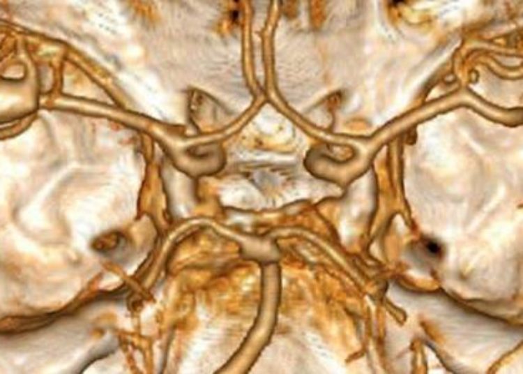Clinical decision rule highly sensitive in predicting subarachnoid hemorrhage