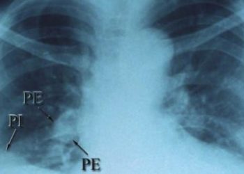 Adult decision rules poor proxy for diagnosing pediatric PE