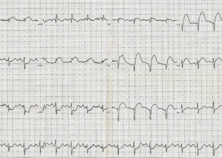 Computer more accurate than clinical gestalt in predicting ACS