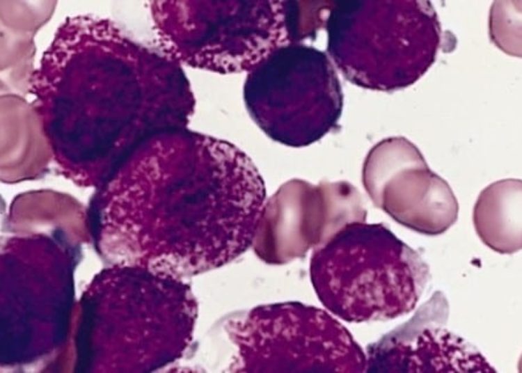 Improved survival with bufulfan-cyclophosphamide combination vs total body irradiation