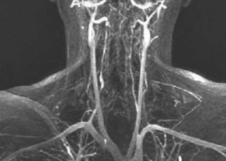 Carotid body ablation effective for congestive heart failure in rats