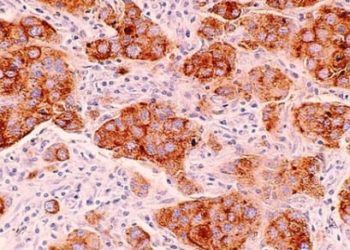 Adjuvant radiotherapy reduces recurrence of ductal carcinoma; no effect on long-term prognosis