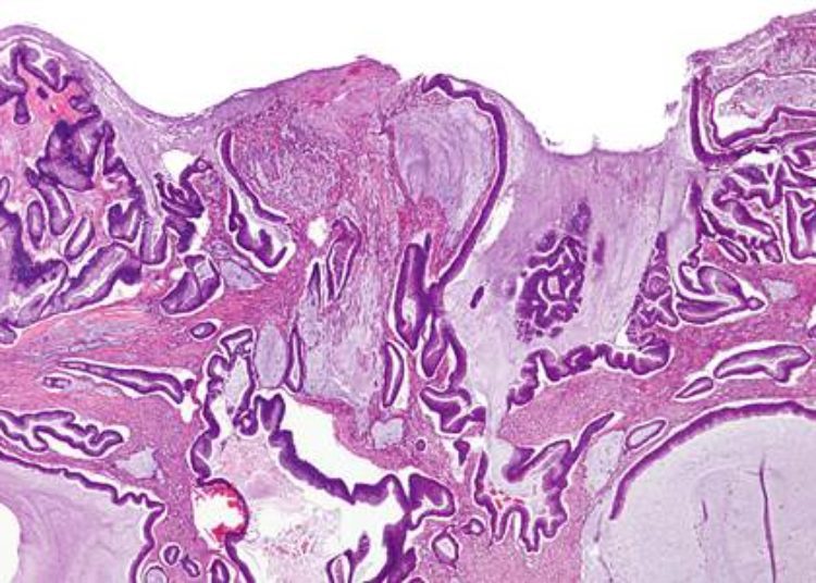 RAS mutation linked with survival in metastatic colorectal cancer