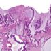 RAS mutation linked with survival in metastatic colorectal cancer
