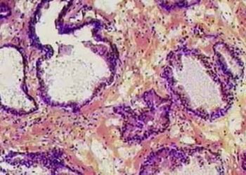 Repeat Transrectal Prostate Biopsies May Increase Infection Risk