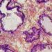 Repeat Transrectal Prostate Biopsies May Increase Infection Risk