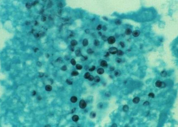A new genetic test for susceptibility to dapsone hypersensitivity syndrome