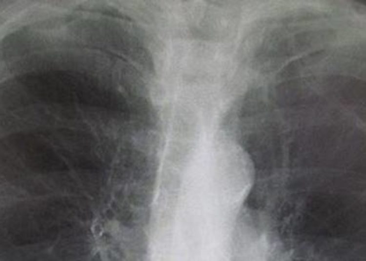 Dual PDE3/PDE4 inhibitor may be effective treatment for asthma and COPD