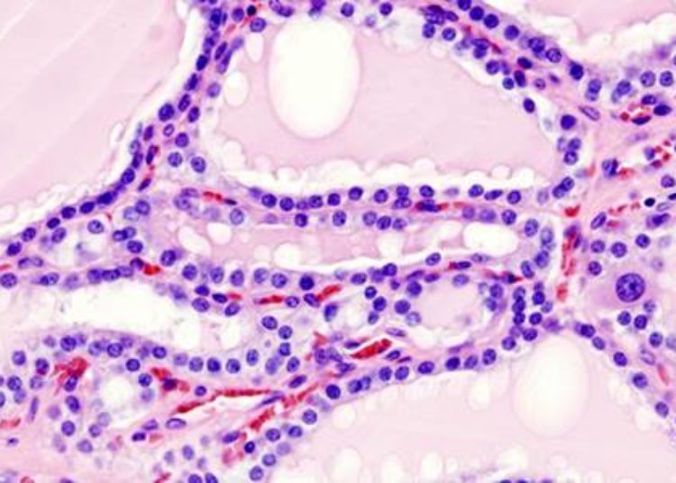 Further evidence of link between antithyroid drugs in pregnancy and birth defects