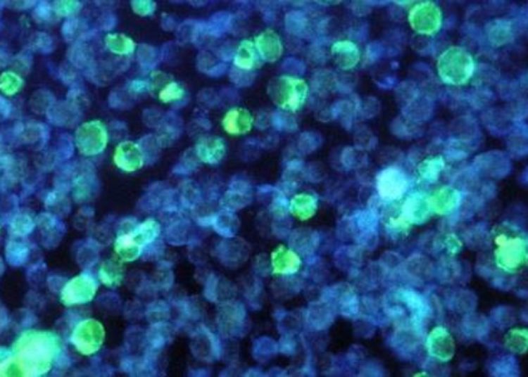 Autologous stem-cell transplantation benefits high-risk patients with non-Hodgkin’s lymphoma