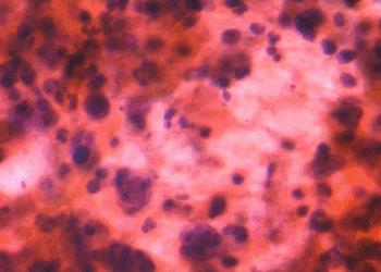 VATS lobectomy may be preferred in COPD with non-small-cell lung cancer