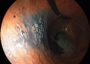 Equivalent efficacy of Paclitaxel or Irinotecan for advanced gastric cancer