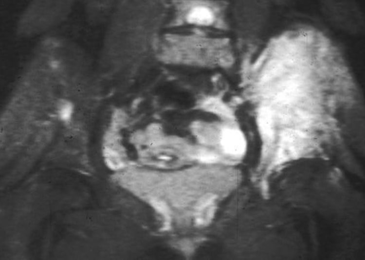 Increased frailty associated with childhood cancer survivorship