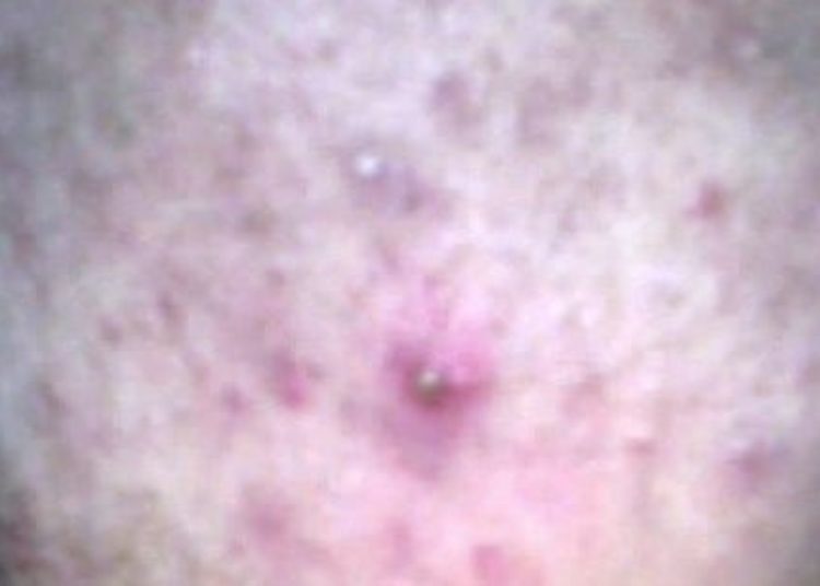 High cumulative-dose isotretinoin treatment decreases risk of acne relapse