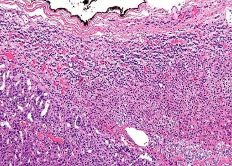 ARMC5 mutation identified in patients with macronodular adrenal hyperplasia
