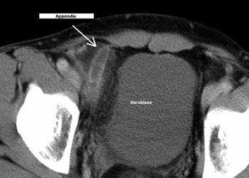 Pediatric appendicitis outcomes in Canada not superior to US