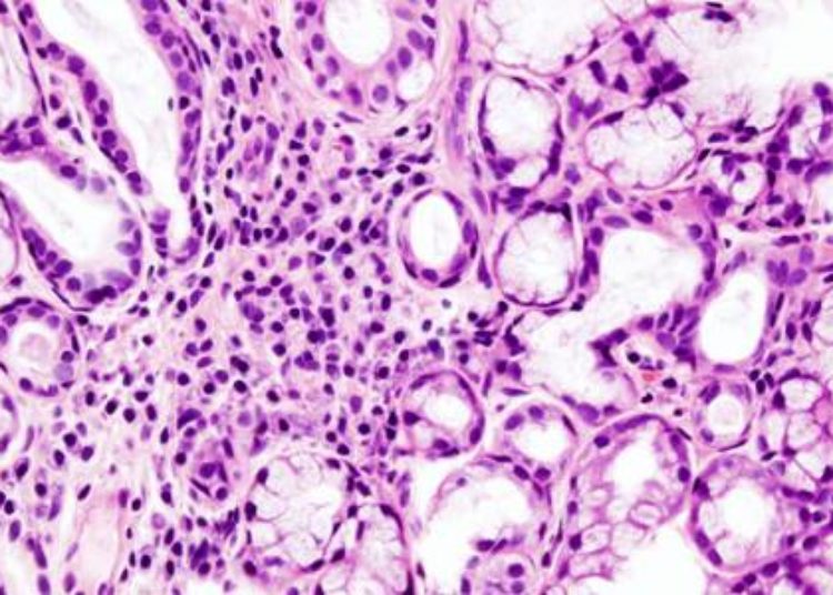 Autoantibodies may precede symptom onset in Sjögren’s Syndrome