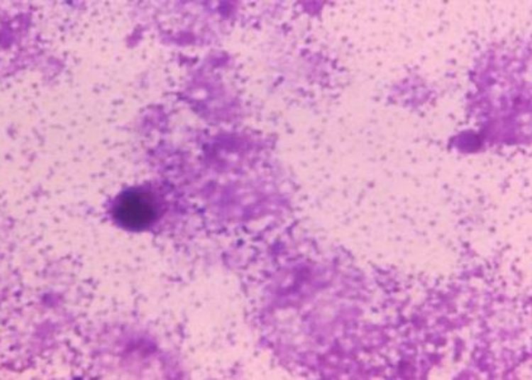 Repeat third trimester syphilis screening may not be cost effective