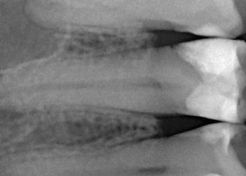 Periodontitis therapy not improving HbA1C levels in type II diabetes patients