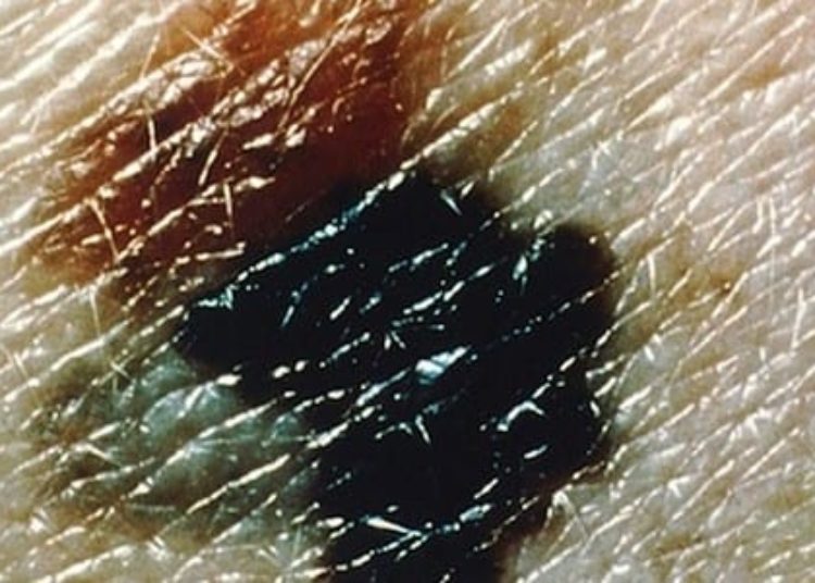 Patients with late stage melanoma remain at risk for further primary melanoma