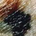 Patients with late stage melanoma remain at risk for further primary melanoma