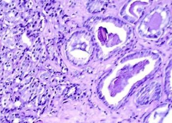 Sunitinib showed no change in overall survival for metastatic prostate cancer