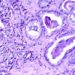 Sunitinib showed no change in overall survival for metastatic prostate cancer