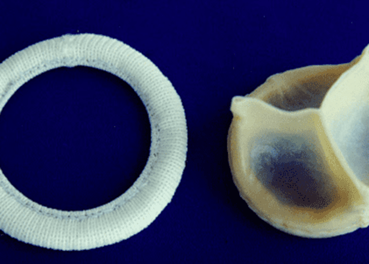 Imaging biomarkers may improve prediction of aortic valve stenosis