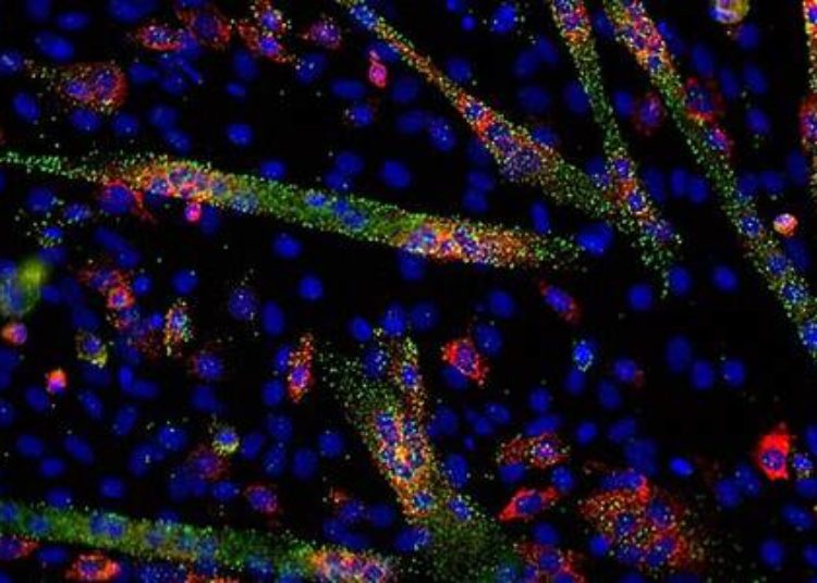 Separate panels of microRNAs may aid in early detection of pancreatic cancer