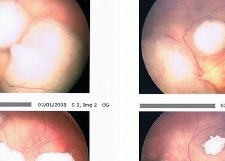 Intravitreal melphalan may control retinoblastoma seeds