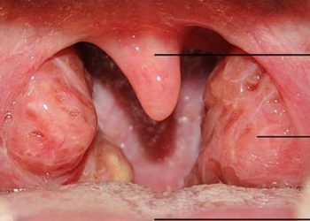 Substantial variation in quality of pediatric tonsillectomy perioperative care