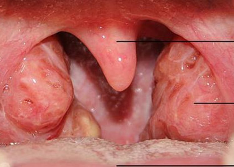 Substantial variation in quality of pediatric tonsillectomy perioperative care