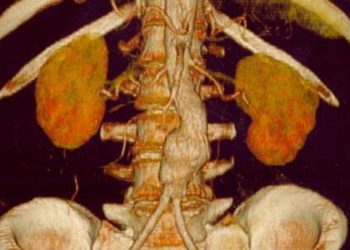 Ultrasound screening for AAAs has no effect on all-cause mortality