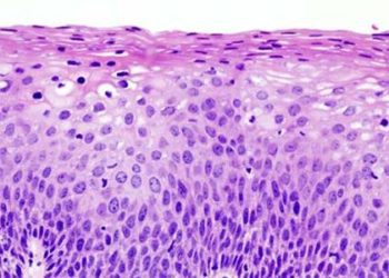 5-FU a promising treatment for CIN-2