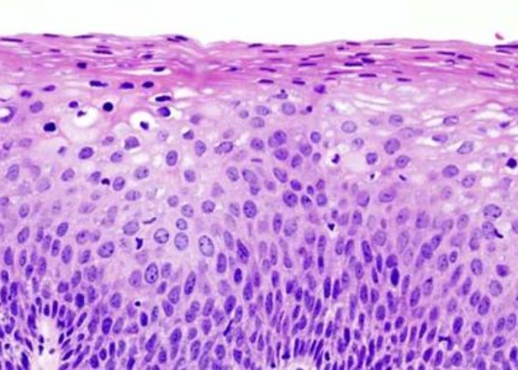 5-FU a promising treatment for CIN-2