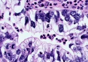 Afatinib shows increased progression-free survival in non-small-cell lung cancer