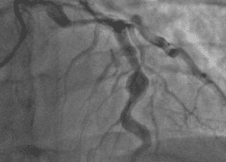 Cardiovascular events in Kawasaki Disease not significantly elevated over controls