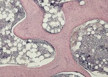 Romosozumab significantly increases bone mineral density in postmenopausal women