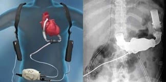 Multi-institutional study finds increased thrombosis in HeartMate II LVADs